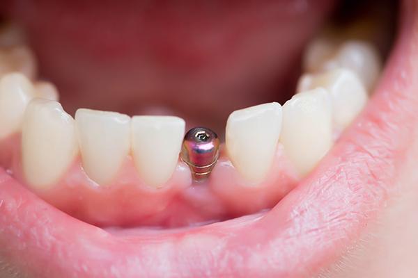 A dental implant abutment