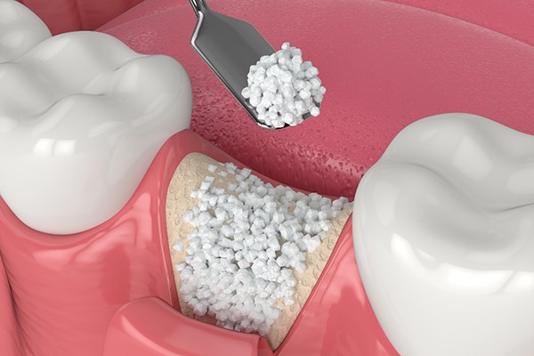 A 3D illustration of dental bone grafting