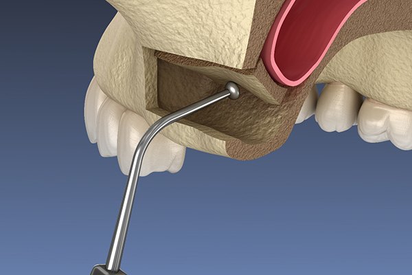 A 3D illustration of a sinus lift