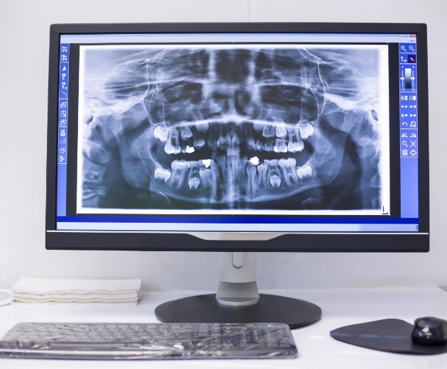 Dental x rays on computer screen in Burke oral surgery office