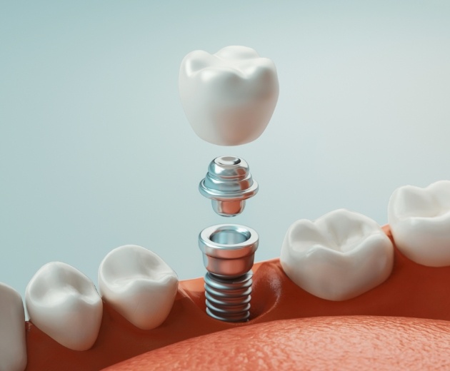 Animated dental implant with dental crown being placed in the mouth