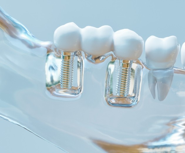 Model of the jaw with two dental implants in Burke