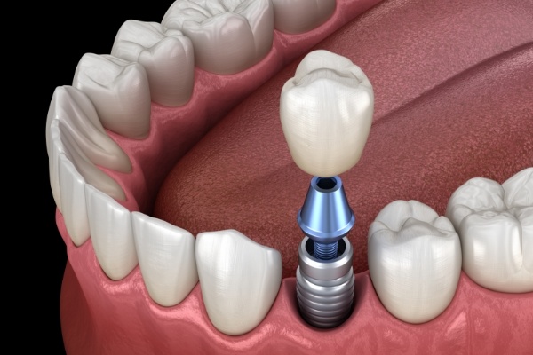 Animated dental implant with a dental crown