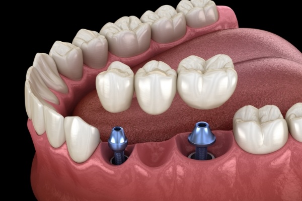 Animated dental bridge with two dental implants