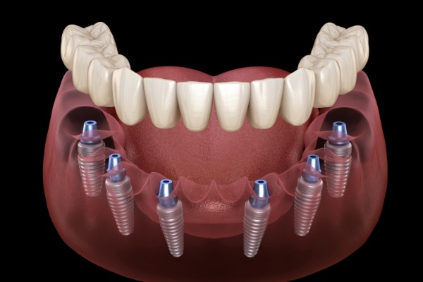 Animated implant denture supported by six dental implants