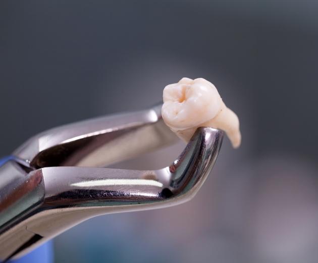 Extracted tooth being held in pair of dental forceps