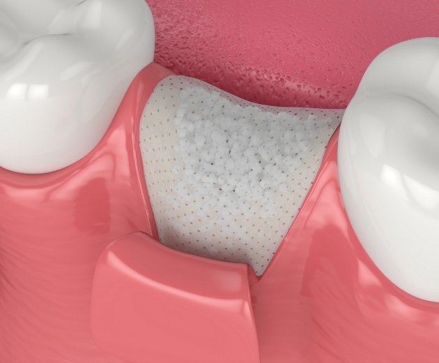 Animated dental bone grafting material in jawbone where missing tooth once was