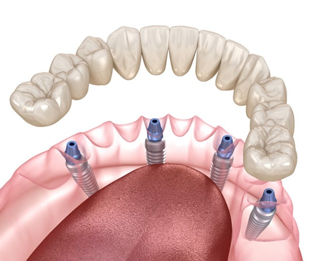 Digital illustration of all-on-4 dentures