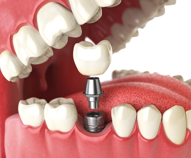 Dental crown abutment and dental implant going into the lower jaw