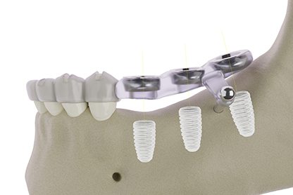 Render of surgical guide for dental implants in Burke, VA