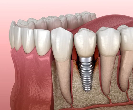 Illustration showing peri-implantitis infection