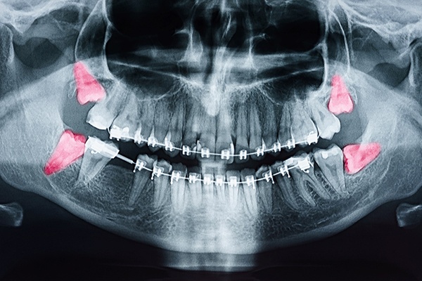 x-ray of impacted teeth