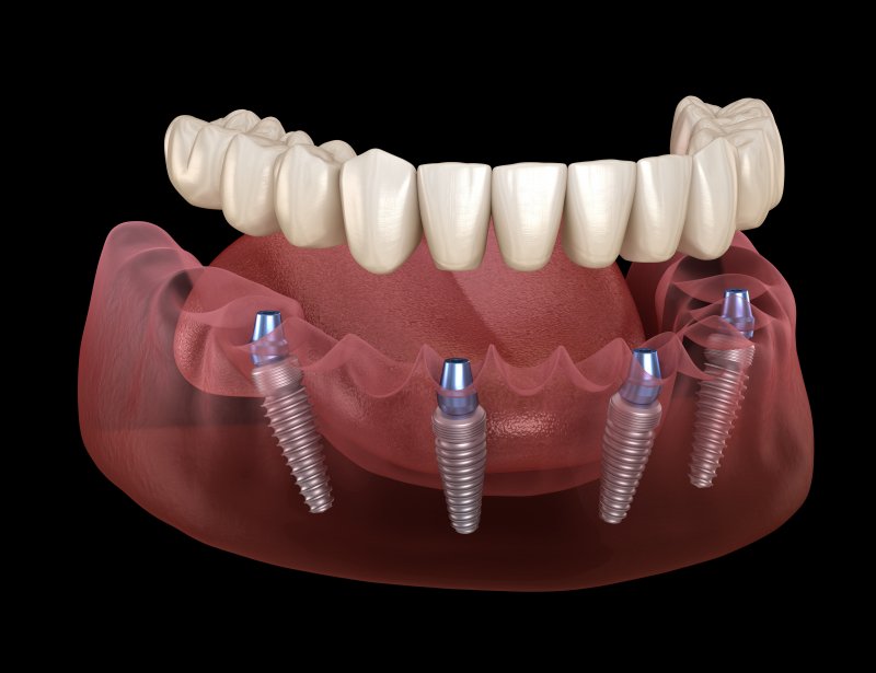 A 3D illustration of All-on-4 implants