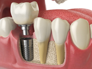 Diagram of a dental implant