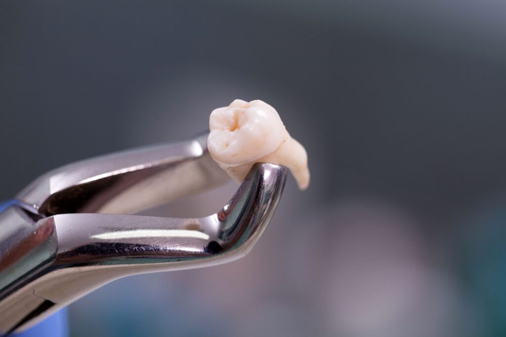 Closeup of an extracted tooth held by forceps