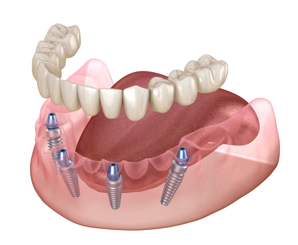 3d illustration of all-on-4 implants with dentures in lower arch